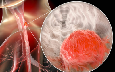 Medical illustration of a cancerous tumor within a blood vessel, with a zoomed inset highlighting the red malignant mass.