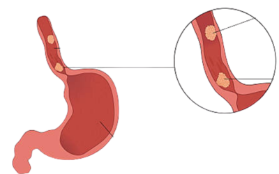 Anatomy diagram of the digestive tract: esophagus leading to a stomach with ulcerations marked; a magnified inset highlights ulcers on the stomach lining.