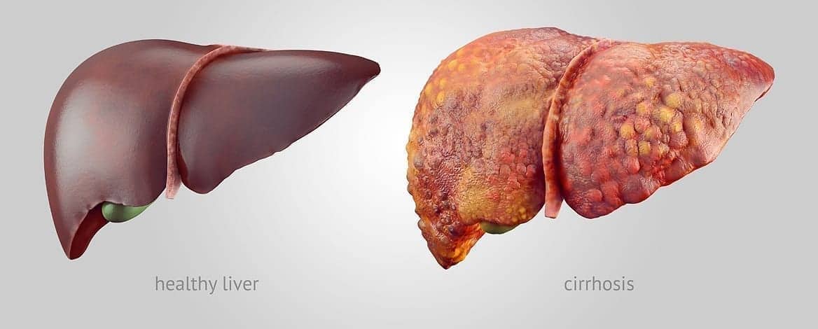 Side-by-side: left healthy liver smooth and dark red; right cirrhotic liver with a mottled, bumpy surface.