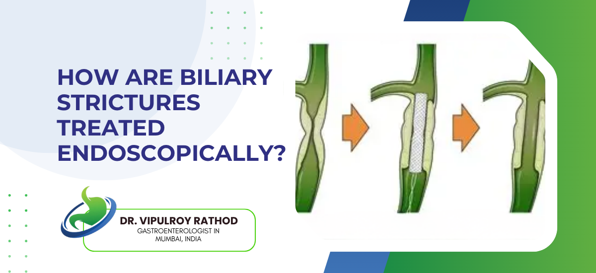 How Are Biliary Strictures Treated Endoscopically?