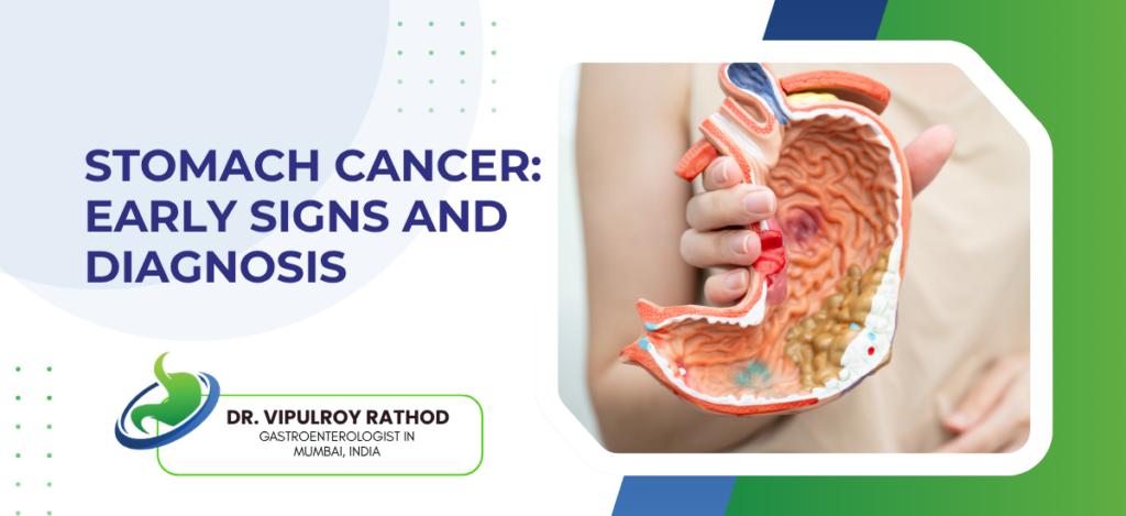 Stomach Cancer Early Signs and Diagnosis