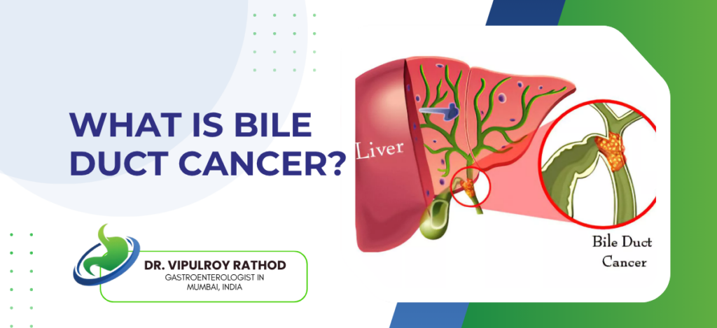 Bile Duct Cancer