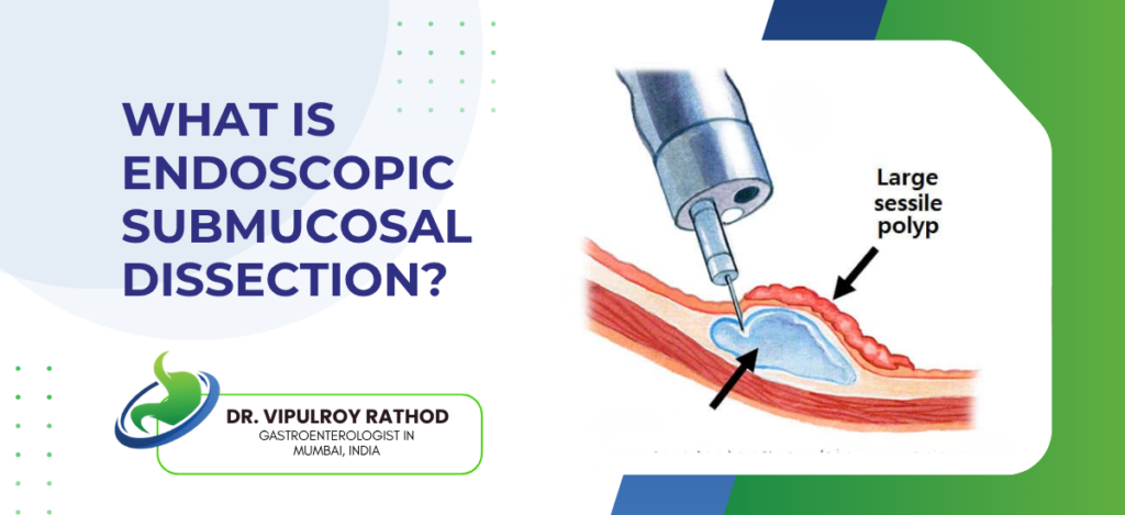 Endoscopic Submucosal Dissection