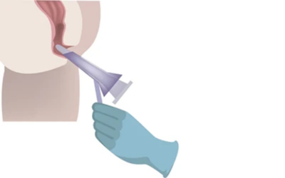 Â___anoscopy and proctoscopy | dr. Vipulroy rathod | dr. Vipulroy rathod Gloved hand using an otoscope to examine a patient's ear.