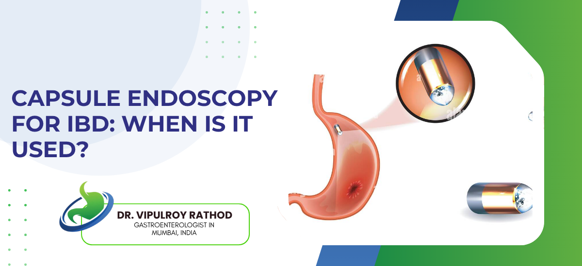 Capsule Endoscopy for IBD: When Is It Used?