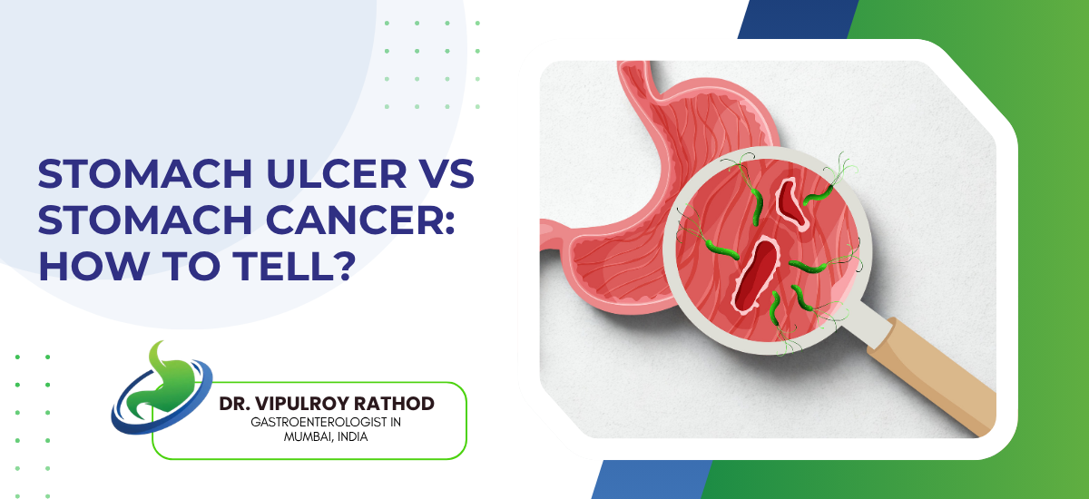 Stomach Ulcer vs Stomach Cancer: How to Tell?