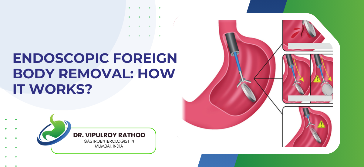 Endoscopic Foreign Body Removal: How It Works?