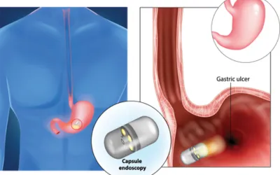 _ capsule endoscopy | dr. Vipulroy rathod | dr. Vipulroy rathod Medical diagram showing a capsule endoscope traveling through the GI tract, with insets of the capsule device and a gastric ulcer in the stomach.