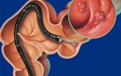 Colonoscopy with ileoscopy and biopsy | dr. Vipulroy rathod | dr. Vipulroy rathod Medical illustration of a colonoscopy: a flexible endoscope inserted into the colon with polyps visible in the mucosa (close-up inset).