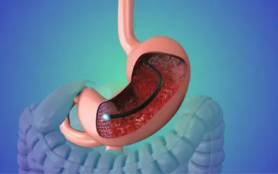 Colonoscopy with biopsy | dr. Vipulroy rathod | dr. Vipulroy rathod An anatomical model of a human stomach showing a bypass tube for bariatric surgery, illustrating gastric bypass anatomy.