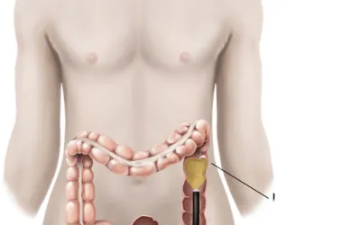 Flexible sigmoidoscopy | dr. Vipulroy rathod | dr. Vipulroy rathod Medical illustration of the lower torso showing the large intestine with a colonoscope inserted from the rectum toward the sigmoid region, highlighting a lesion/polyp.