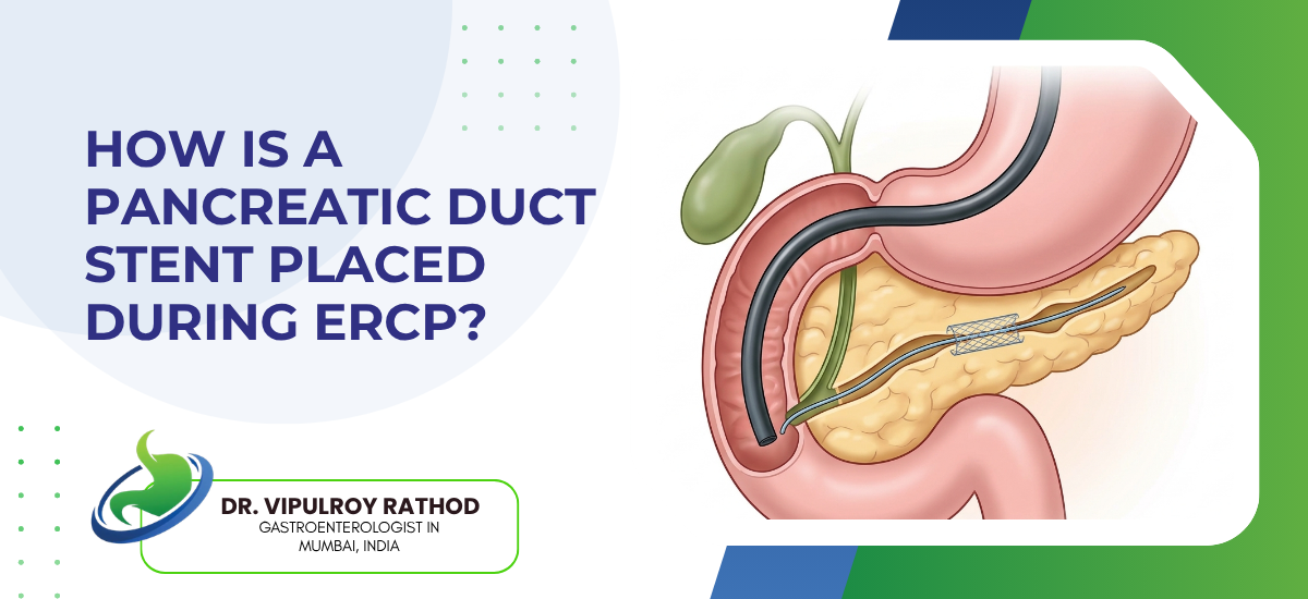 How Is a Pancreatic Duct Stent Placed During ERCP